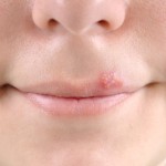 Herpes Labial Vírus | Herpes na boca