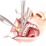 Bichectomia é a nova moda entre os adeptos da cirurgia estética