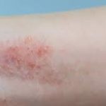 Dermatite Atópica  | Cuidados com a pele